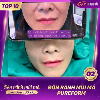 ĐỘN RÃNH MŨI MÁ
